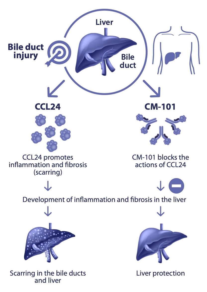 用于治疗原发性硬化性胆管炎的 CM-101 获得 FDA 快速通道认证