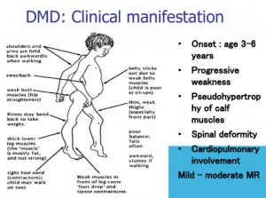 FDA批准Agamree(vamorolone)治疗杜氏肌营养不良症