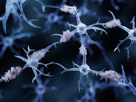 amyloid-alzheimers-nerve-cells.jpg