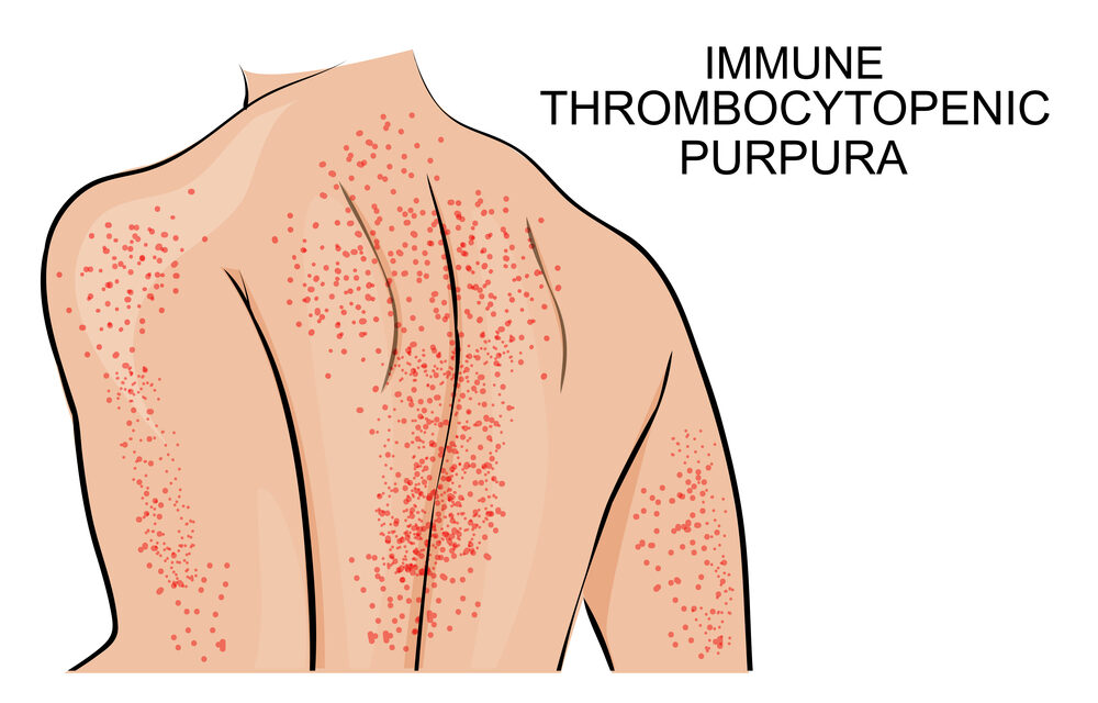 What-is-ITP-Blood-Disorder-1000x640.jpg