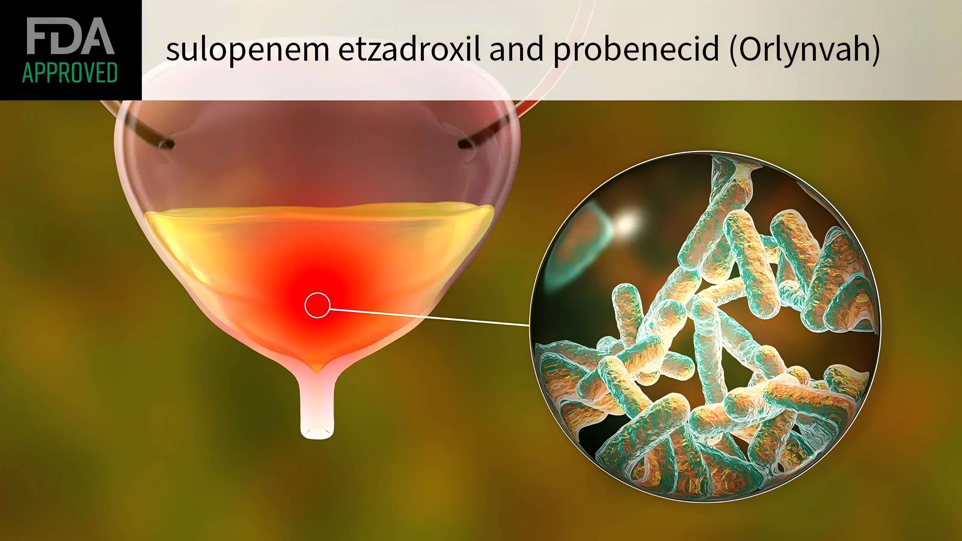 FDA 批准 Orlynvah（sulopenem etzadroxil & probenecid）用于治疗非复杂性尿路感染